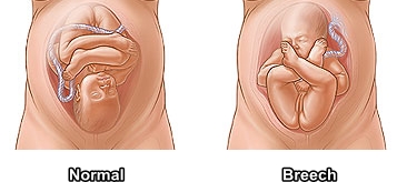 breech-normal